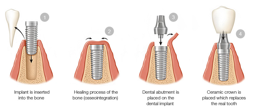 Dental Implants Linhart Dentistry