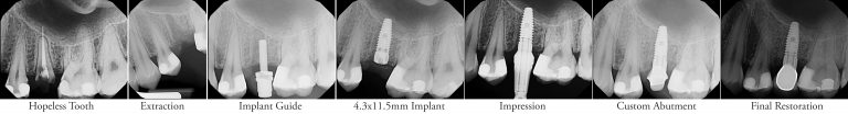 Dental Implants - Linhart Dentistry